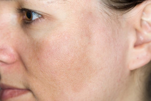 وصفات لعلاج كلف الوجه 