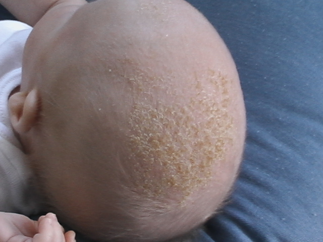 قشرة الرأس عند الرضع وطرق علاجها
