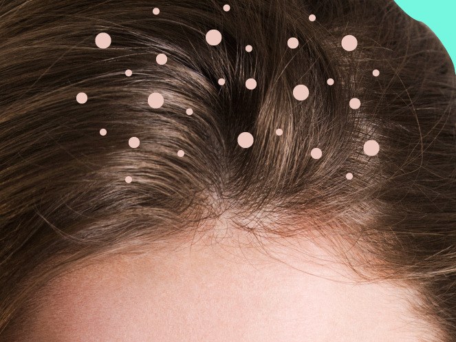 طرق لحماية الشعر من القشرة